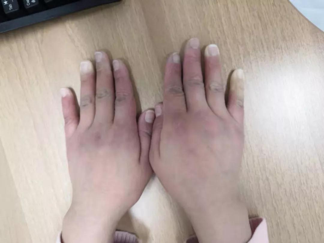 “手指、腳趾發(fā)白、發(fā)紫……”這些“小毛病”千萬別大意
