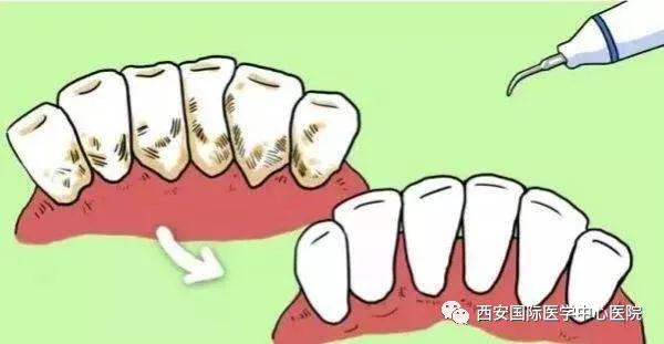 【科普】牙齒上的黃斑好難看，三招告訴你如何預防氟斑牙