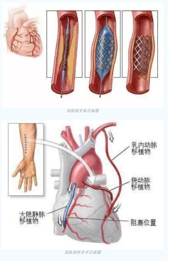 魚(yú)與熊掌不可兼得？冠脈雜交手術(shù)一站式解決問(wèn)題
