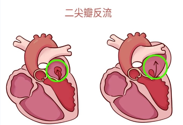 體檢報告里的心臟瓣膜返流，你讀懂了嗎？